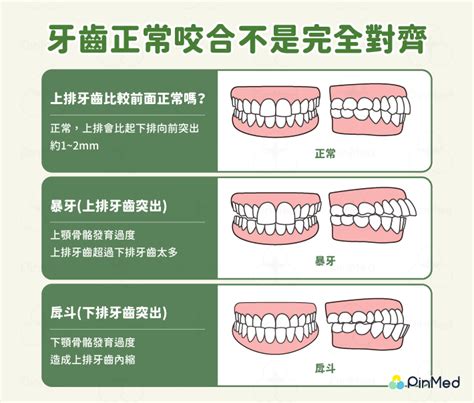 上排牙齒蓋住下排牙齒|咬合不正怎麼辦？3分鐘認識咬合類型、症狀與矯正方。